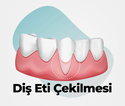 Diş Eti Çekilmesi
