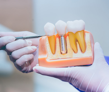 Diş çekiminden hemen sonra implant yapılır mı?