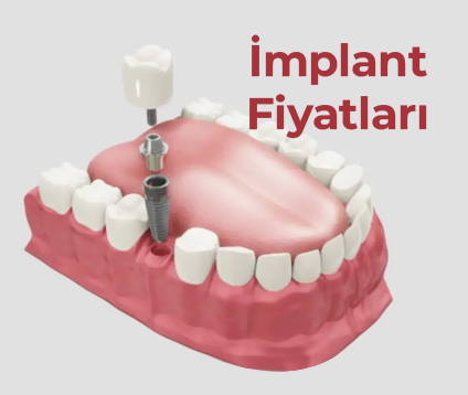 İmplant Fiyatları 2026 | Güncel Tek Diş İmplant Fiyatları